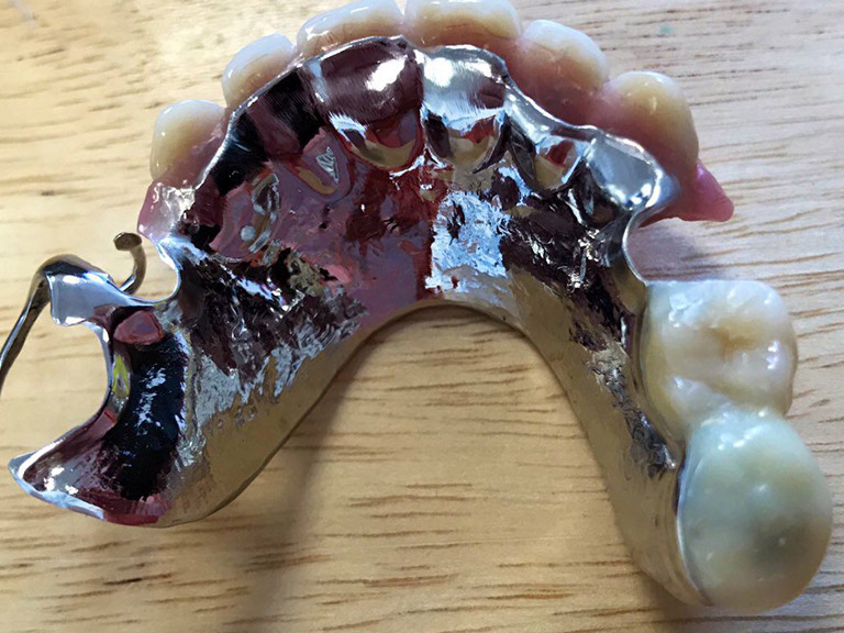 Partial Dentures Horwich Denture Clinic Bolton Lancashire Northwest