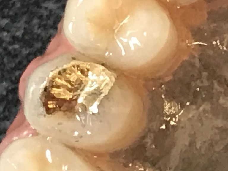 Bespoke Dentures Horwich Denture Clinic Bolton Lancashire Northwest