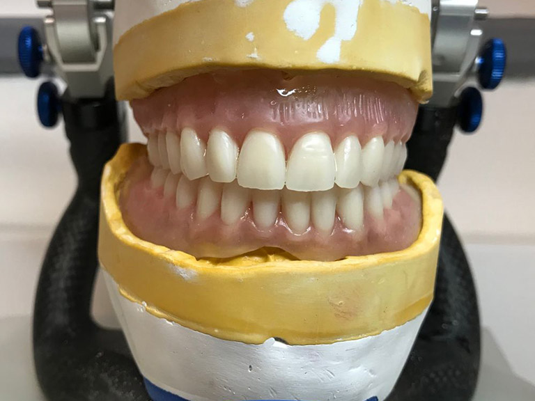 Complete Dentures Horwich Denture Clinic Bolton Lancashire Northwest