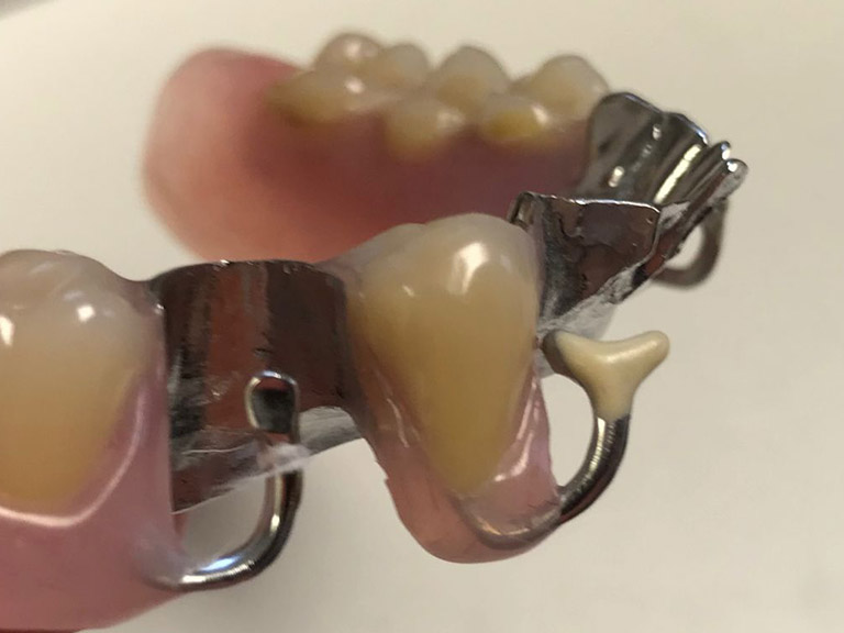 Partial Dentures Horwich Denture Clinic Bolton Lancashire Northwest