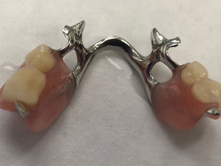 Partial Dentures Horwich Denture Clinic Bolton Lancashire Northwest