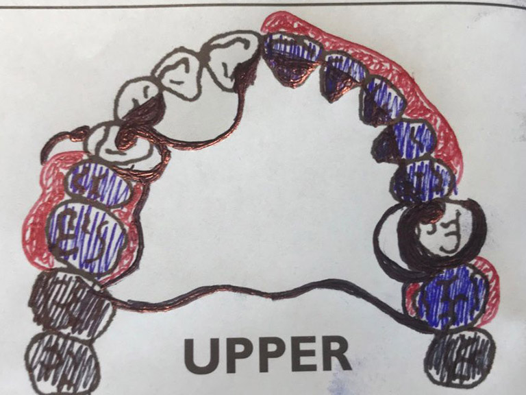 Partial Dentures Horwich Denture Clinic Bolton Lancashire Northwest